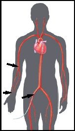 Insertion sites may be in the groin or the arm