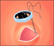 Image of aorta